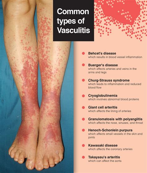 Vasculitis .